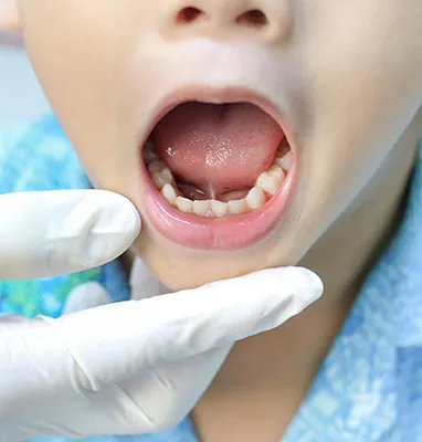 Tongue-tie evaluation at Bonded Beginnings